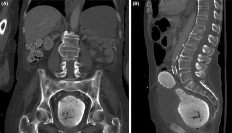 no one wants to test for impacted feces|rectal impaction test results.